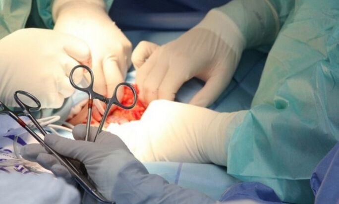 Ligamentotomia – operacja powiększania penisa